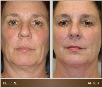 Thermage - Before & Afters