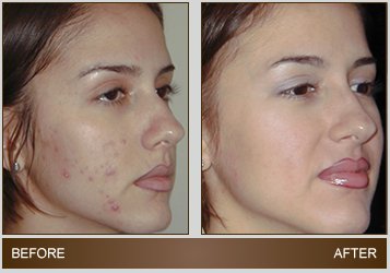 ClearLight Acne Treatment